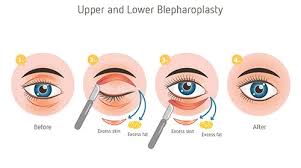 Revealing the Beauty of Upper Blepharoplasty: Your Guide to Recovery
